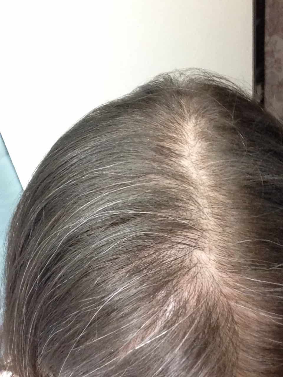 This was my hair in 2014 prior to my diagnosis with an autoimmune disease. I can see the hair loss pattern now, but at the time I didn't know what to look for! | via Autumn All Along
