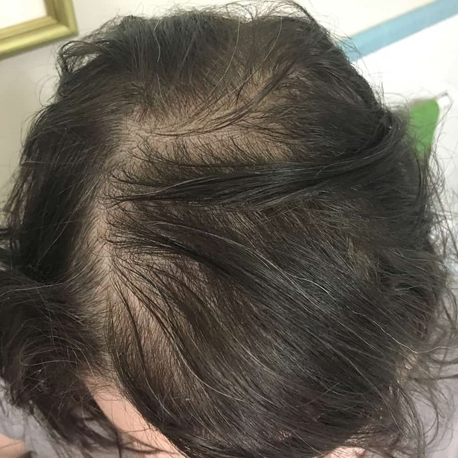 female hair loss in my 20s: my update and FAQs after a year — Autumn all  along