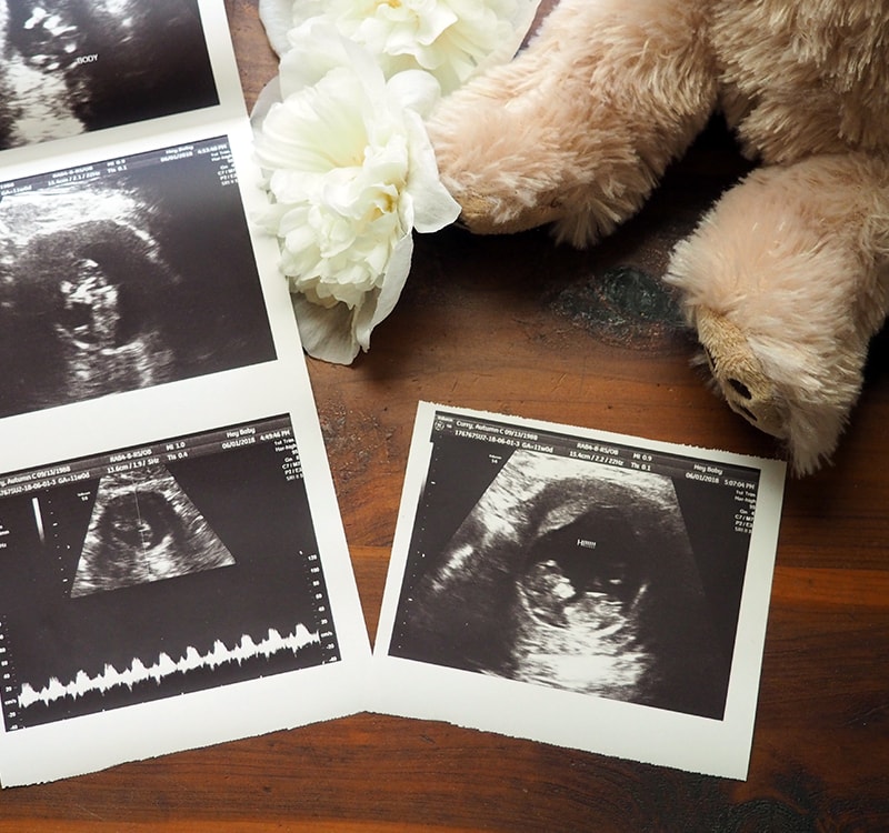 10.5 week ultrasound picture | via Autumn All Along